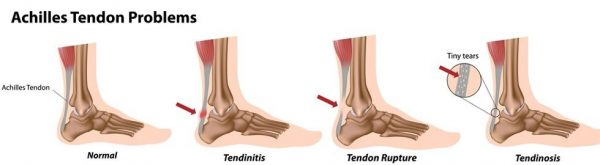 types of achilles tendon problems