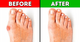 before and after picture of bunions