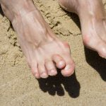 Hammertoe