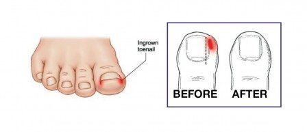 before and after treatment of ingrown toenail