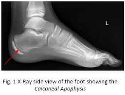xray showing calcaneal apophysis