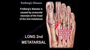 Frieberg Disease 