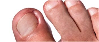 inflamed ingrown toenails