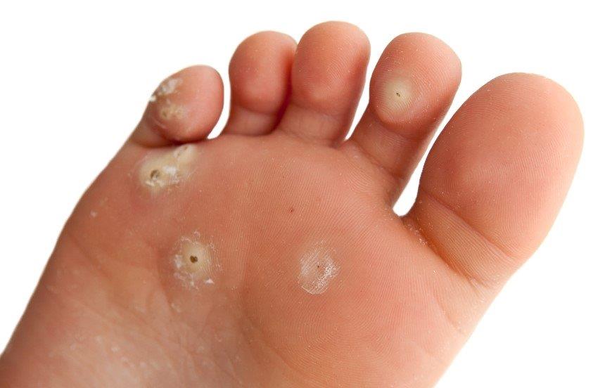 Wart Treatments Papilloma Verrucae The Foot And Ankle Clinic