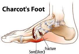 illustration of charcot's foot