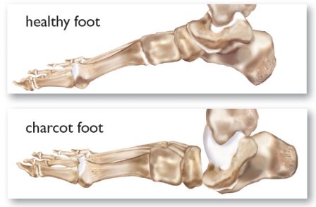 illustration showing difference between healthy foot and charcot foot