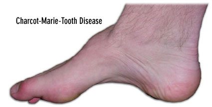 photo of charcot-marie-tooth disease