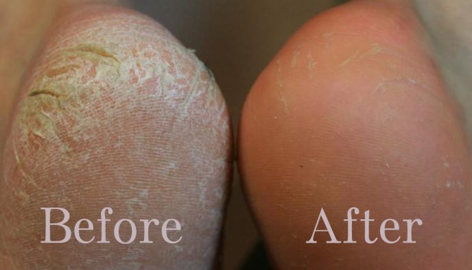 photo of before and after cracked heel treatment