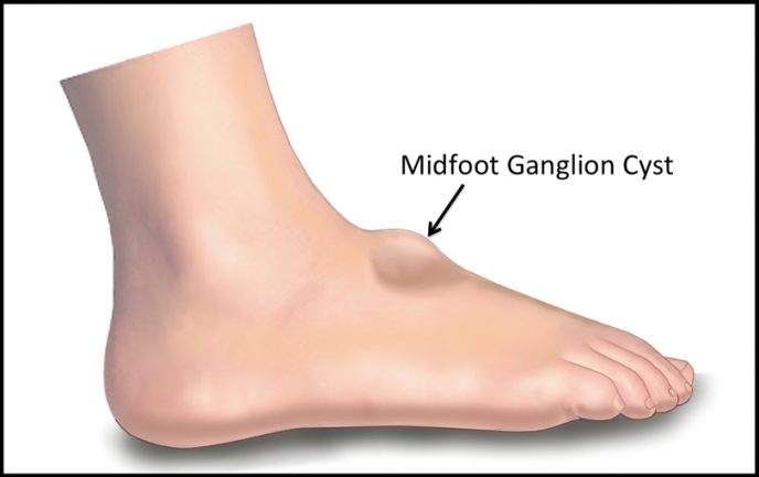 illustration of midfoot ganglion cyst
