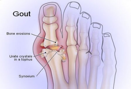 illustration showing gout in foot