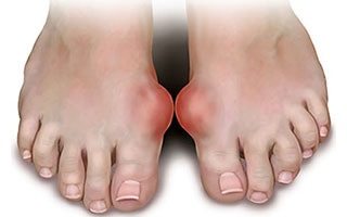 illustration of gout on two feet