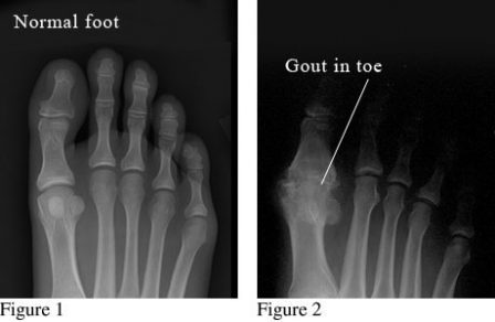 xray comparison of gout and no gout