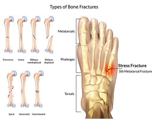 diagram of types of bone stress fractures of the foot