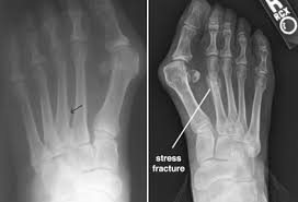 xray of stress fracture