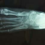 Kohler's Disease