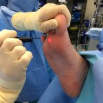 laser treatment