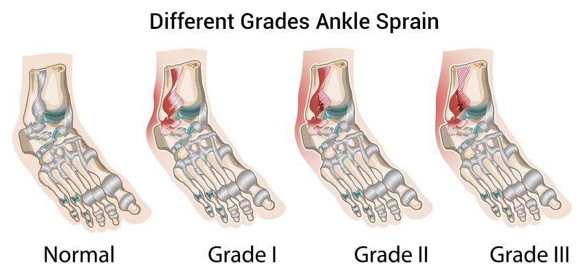 Ankle Sprains The Foot and Ankle Clinic