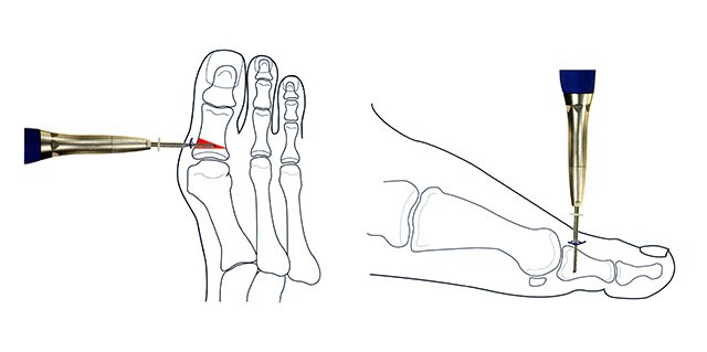 minimally invasive foot surgery