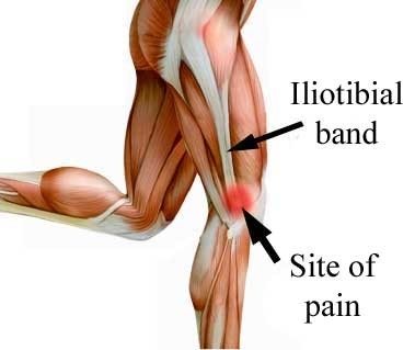 Iliotibial band syndrome - The Foot and Ankle Clinic