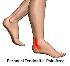 Peroneal tendonitis