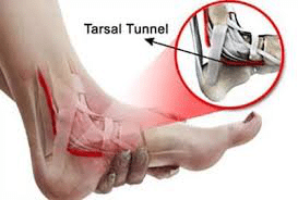 Tarsal Tunnel Syndrome