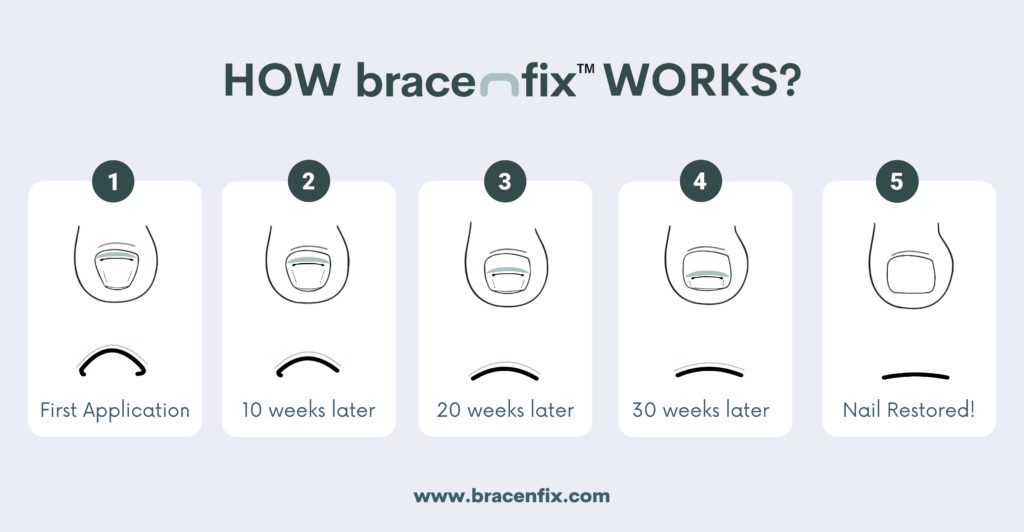 Bracenfix Process